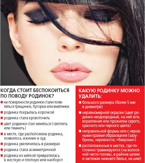 Какие родинки нужно удалять и стоит ли делать это летом?, фото №1 на сайті 20minut.ua