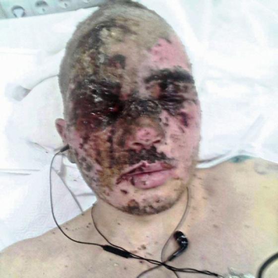 24-річного Миколу Казакова після тяжкого поранення в АТО знов відправили на війну, фото №1 на сайті 20minut.ua